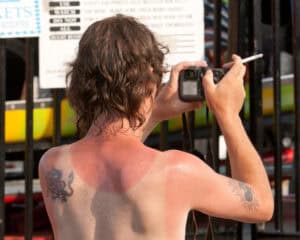 Person with sunburnt back